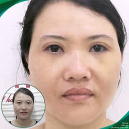 Thẩm mỹ Ruby Beauty - Bác sĩ Lương Ngọc|Thẩm mỹ mắt đẹp