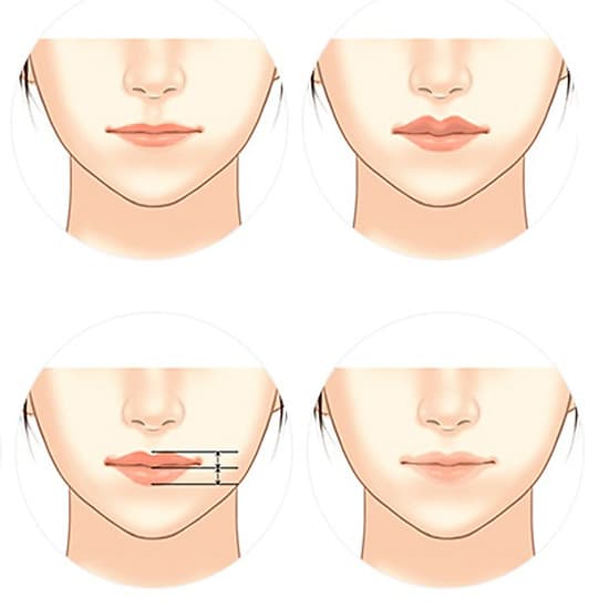 Thẩm Mỹ Ruby Beauty - Bác sĩ Lương Ngọc|Đôi Môi Quyến Rũ - Thu Hút Ánh Nhìn