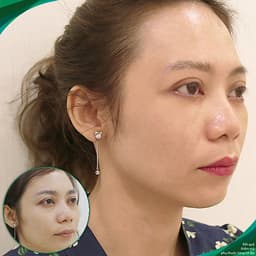 Thẩm mỹ Ruby Beauty - Bác sĩ Lương Ngọc|Thẩm mỹ mắt đẹp