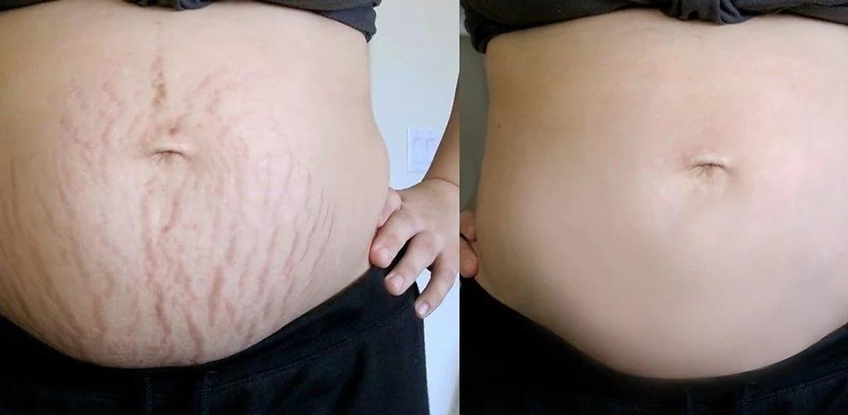 TMV SAIGON BEUTY -  ĐIỀU TRỊ RẠN DA CÔNG NGHỆ LASER HIỆU QUẢ CAM KẾT 
