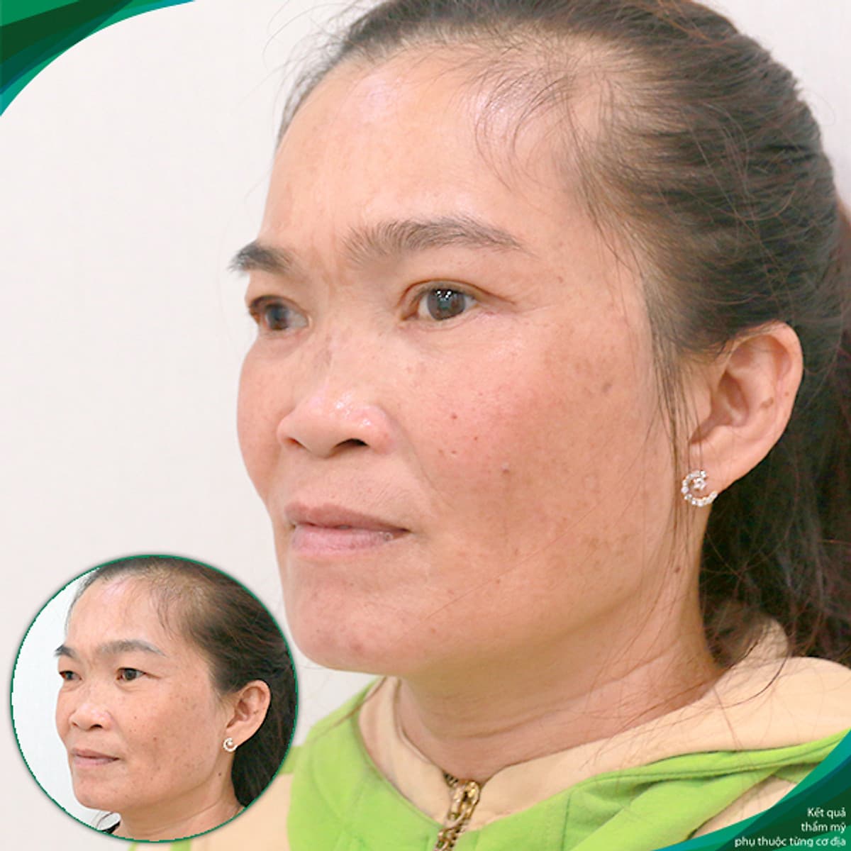 Thẩm mỹ Ruby Beauty - Bác sĩ Lương Ngọc|Thẩm mỹ mắt đẹp