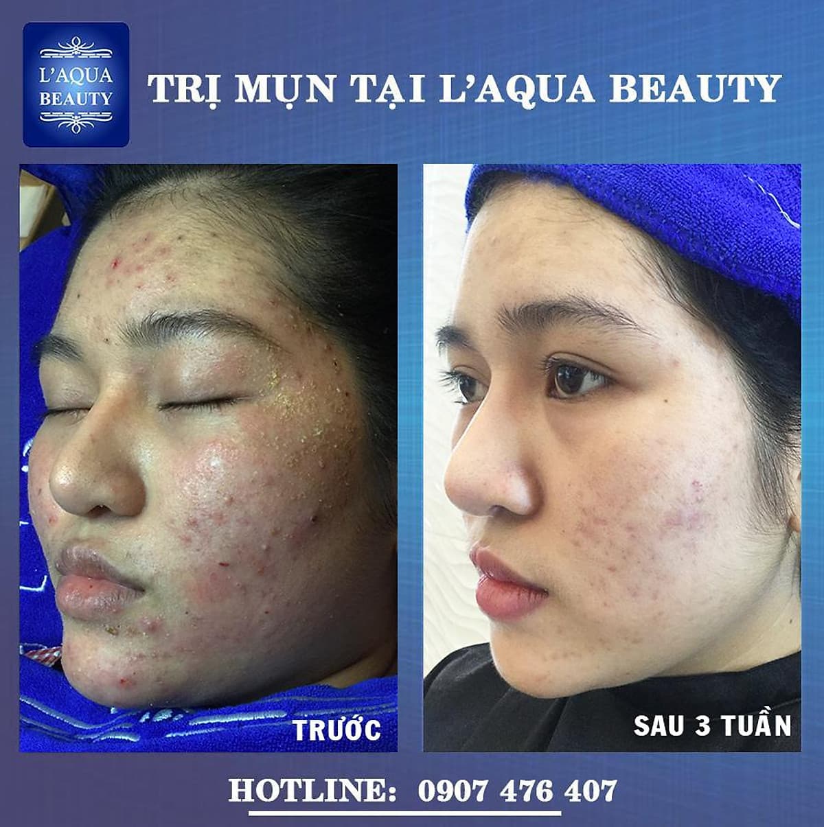 DETOX DA - CHĂM SÓC DA MỤN VỚI 8N1 TẠI L’AQUA BEAUTY