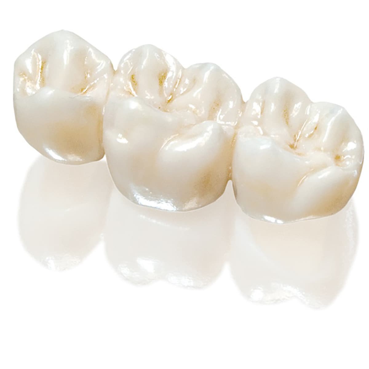 Bọc 1 răng sứ Cercon HT tại Nha Khoa Gia Hân