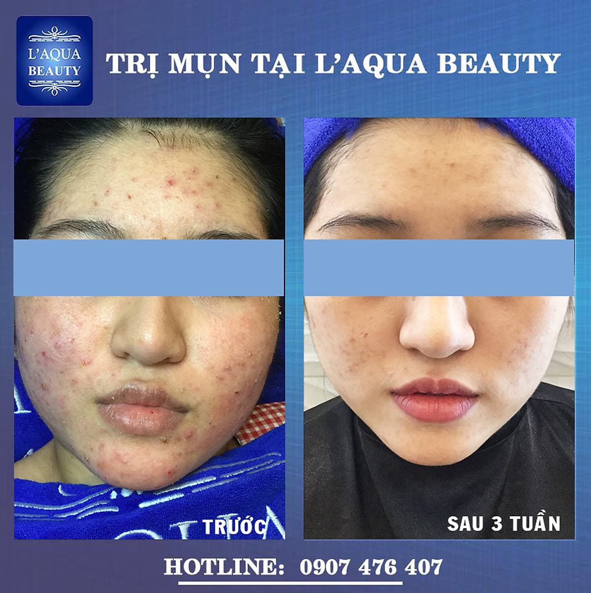 DETOX DA - CHĂM SÓC DA MỤN VỚI 8N1 TẠI L’AQUA BEAUTY