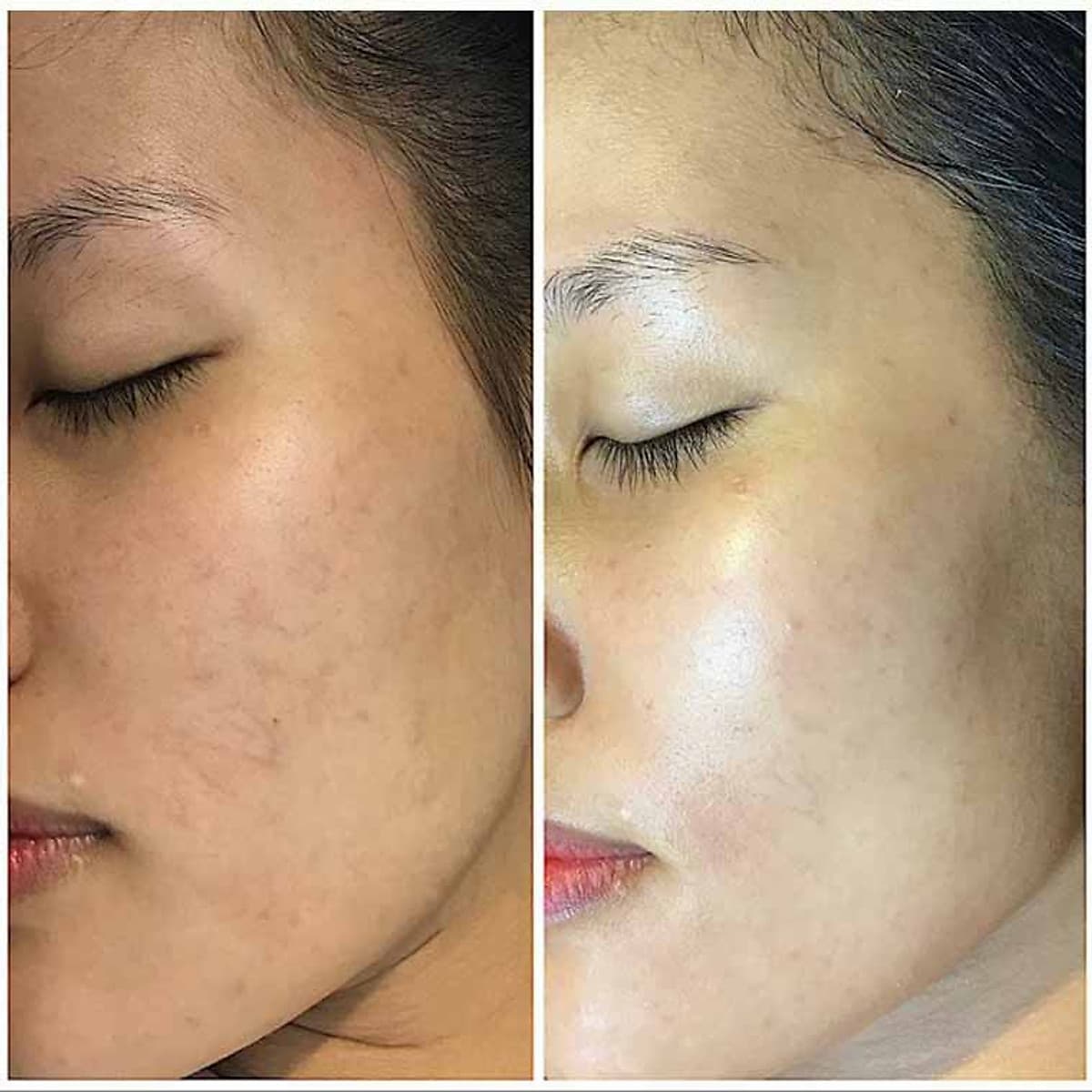 1 Trong Các DỊch Vụ Chăm Sóc Da Mặt Thư Giãn Tuyệt Đối Tại Ấm Brows & Spa