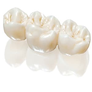 Bọc 1 răng sứ Cercon HT tại Nha Khoa Gia Hân