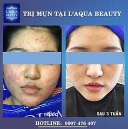 DETOX DA - CHĂM SÓC DA MỤN VỚI 8N1 TẠI L’AQUA BEAUTY