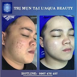 DETOX DA - CHĂM SÓC DA MỤN VỚI 8N1 TẠI L’AQUA BEAUTY