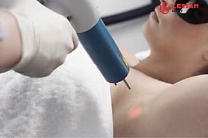 TRẺ HÓA LÀM SÁNG VÙNG NÁCH TẠI VIỆN THẨM MỸ LES SAM